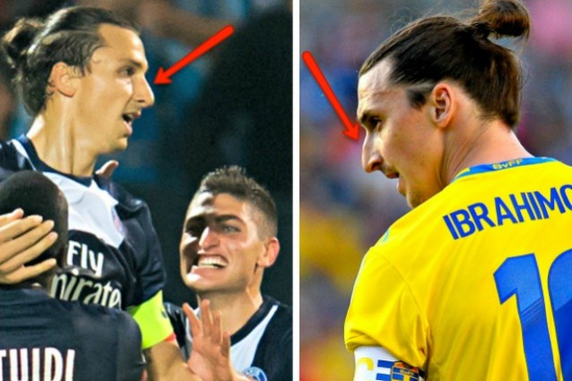 Zlatan Ibrahimovic burun estetiği yaptırdı